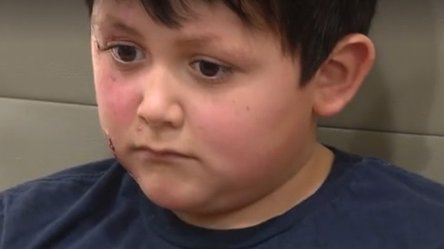 TikTok trend leaves 9-year-old boy with severe burns from microwaved ‘NeeDoh’ toy