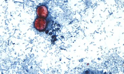 Cyclospora cases mounting in Michigan